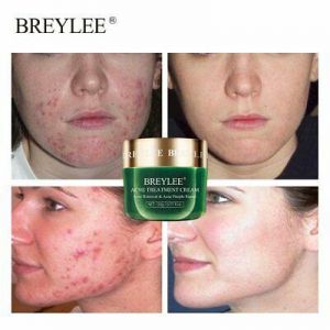Super Beauty | מוצרי איפור וטיפוח טיפוח    BREYLEE Anti Acne Cream Acne Treatment Facial Cream Pimple Spots Remover Serum O
